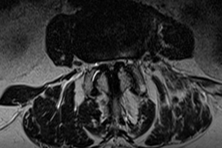 MRT Spinalkanalsrenose