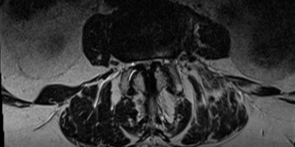 Spinalkanalstenose MRT Spinalkanalsrenose