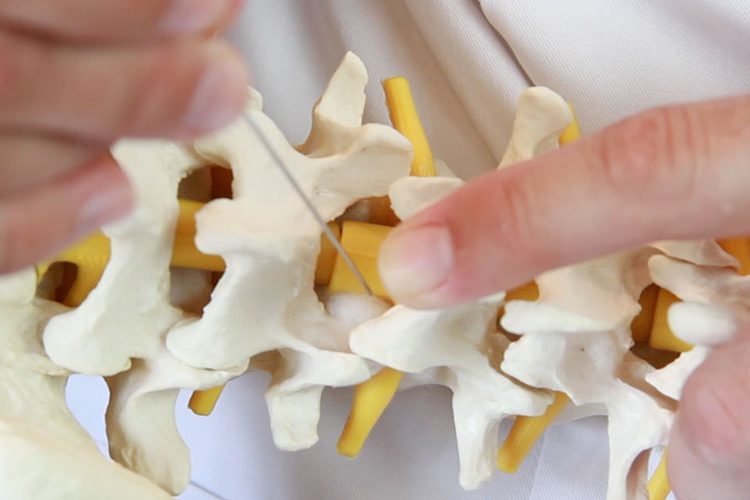 Bandscheibenvorfall; Behandlung