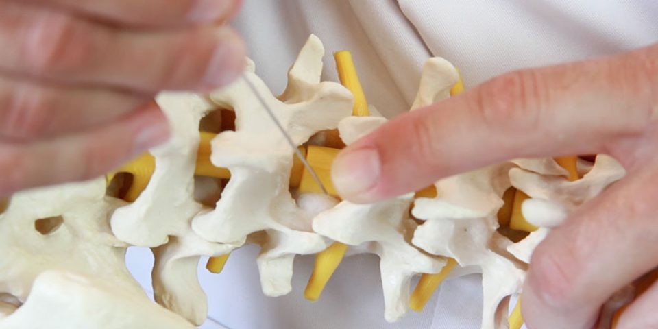 Bandscheibenvorfall; Behandlung